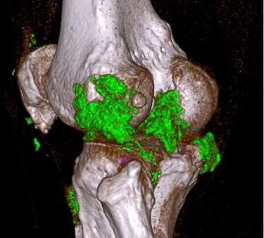 What-causes-gout-thumbnail
